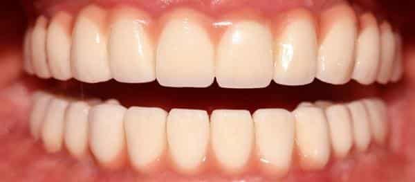 edentulous patient after restoration with dental implants in New Smile Costa Rica