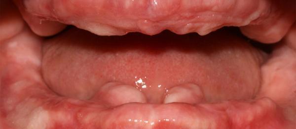 edentulous patient before restoration with dental implants  in New Smile Costa Rica