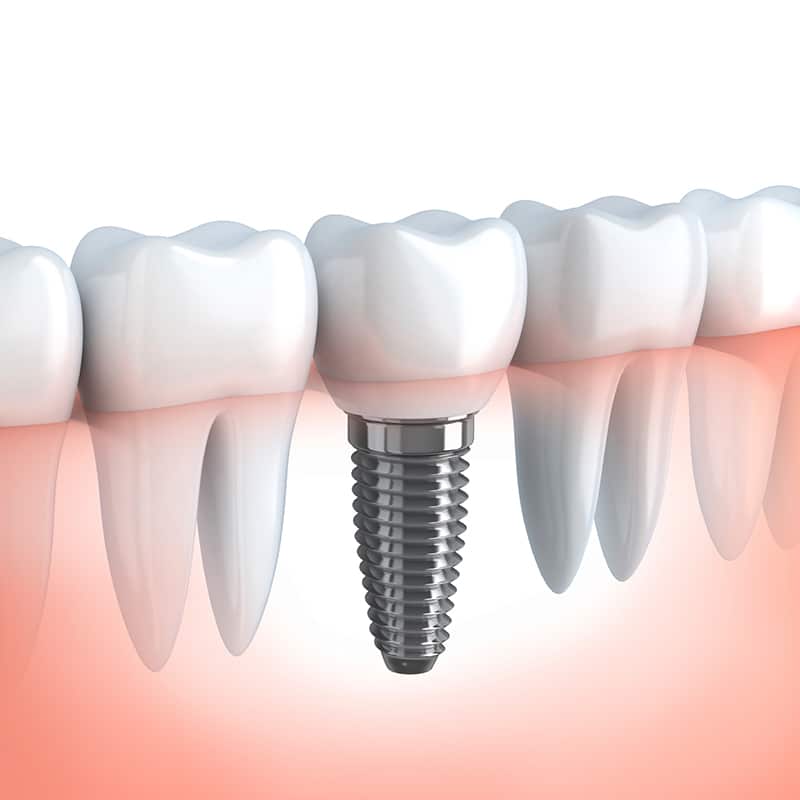 dental implants