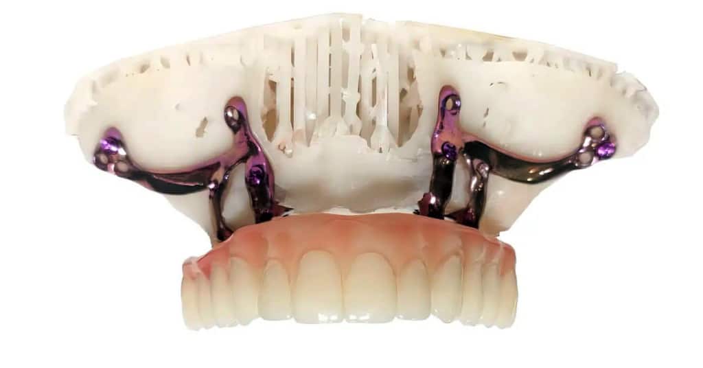 subperiosteal dental implants in New Smile Costa Rica